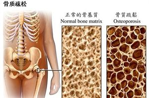 骨质疏松