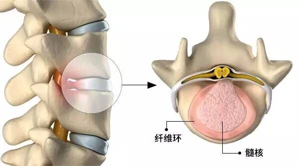 椎间盘结构