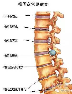 椎间盘常见病变