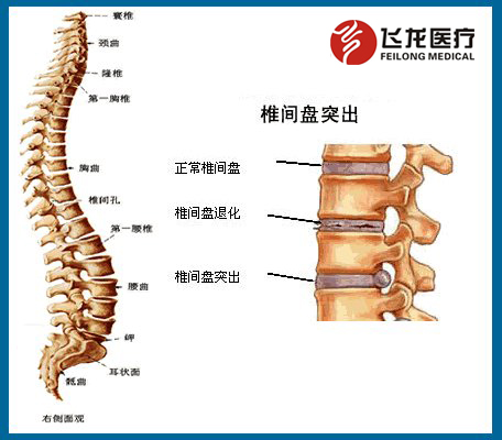 椎间盘突出症状