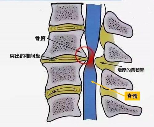 椎间盘退变