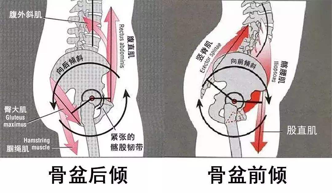 骨盆后倾